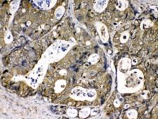 PPIA / Cyclophilin A Antibody - IHC testing of FFPE human intestinal cancer tissue with Cyclophilin A antibody at 1ug/ml. Required HIER: steam section in pH6 citrate buffer for 20 min and allow to cool prior to testing.
