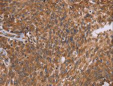 PPIB / Cyclophilin B Antibody - Immunohistochemistry of paraffin-embedded Human ovarian cancer using PPIB Polyclonal Antibody at dilution of 1:45.