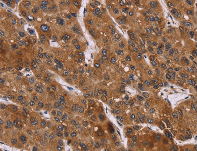 PPIB / Cyclophilin B Antibody - Immunohistochemistry of paraffin-embedded Human liver cancer using PPIB Polyclonal Antibody at dilution of 1:45.