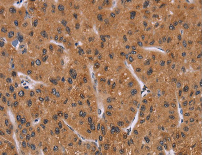 PPIB / Cyclophilin B Antibody - Immunohistochemistry of paraffin-embedded Human liver cancer using PPIB Polyclonal Antibody at dilution of 1:40.