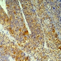 PPIB / Cyclophilin B Antibody - Immunohistochemical analysis of Cyclophilin B staining in human Hepatocarcinoma;human pancreatic cancer formalin fixed paraffin embedded tissue section. The section was pre-treated using heat mediated antigen retrieval with sodium citrate buffer (pH 6.0). The section was then incubated with the antibody at room temperature and detected using an HRP conjugated compact polymer system. DAB was used as the chromogen. The section was then counterstained with hematoxylin and mounted with DPX.