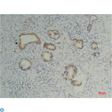 PPIB / Cyclophilin B Antibody - Immunohistochemistry (IHC) analysis of paraffin-embedded Human Pancreatic Carcinoma using Cyclophilin B Mouse Monoclonal Antibody diluted at 1:200.