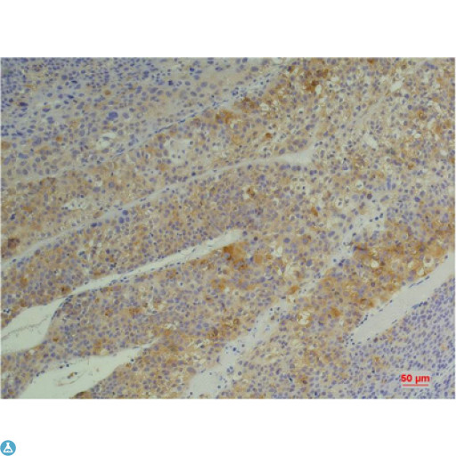 PPIB / Cyclophilin B Antibody - Immunohistochemistry (IHC) analysis of paraffin-embedded Human Heptacarcinoma using Cyclophilin B Mouse Monoclonal Antibody diluted at 1:200.