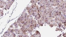 PPIC / Cyclophilin C Antibody - 1:100 staining human pancreas carcinoma tissue by IHC-P. The sample was formaldehyde fixed and a heat mediated antigen retrieval step in citrate buffer was performed. The sample was then blocked and incubated with the antibody for 1.5 hours at 22°C. An HRP conjugated goat anti-rabbit antibody was used as the secondary.