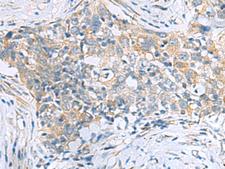 PPIC / Cyclophilin C Antibody - Immunohistochemistry of paraffin-embedded Human esophagus cancer tissue  using PPIC Polyclonal Antibody at dilution of 1:50(×200)