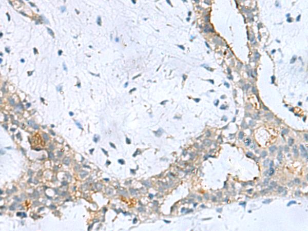 PPIC / Cyclophilin C Antibody - Immunohistochemistry of paraffin-embedded Human breast cancer tissue  using PPIC Polyclonal Antibody at dilution of 1:50(×200)