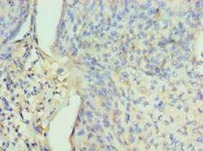 PPID / Cyclophilin D Antibody - Immunohistochemistry of paraffin-embedded human cervical cancer using antibody at 1:100 dilution.
