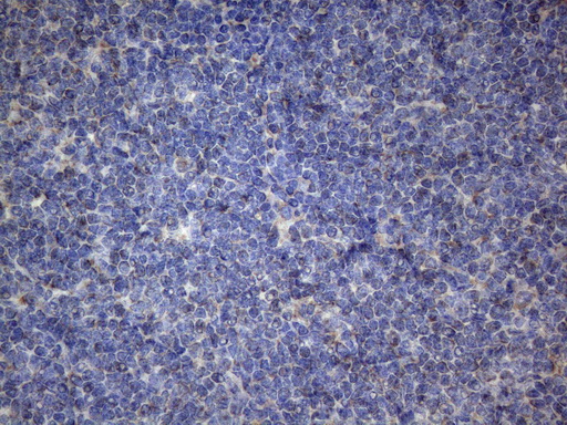 PPIF / Cyclophilin F Antibody - Immunohistochemical staining of paraffin-embedded Human lymphoma tissue using anti-PPIF mouse monoclonal antibody. (Heat-induced epitope retrieval by 1mM EDTA in 10mM Tris buffer. (pH8.5) at 120°C for 3 min. (1:150)