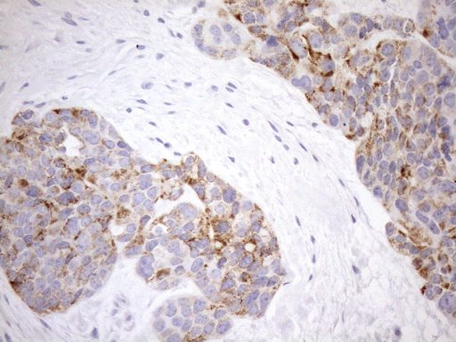 PPIF / Cyclophilin F Antibody - Immunohistochemical staining of paraffin-embedded Adenocarcinoma of Human endometrium tissue using anti-PPIF mouse monoclonal antibody. (Heat-induced epitope retrieval by 1mM EDTA in 10mM Tris buffer. (pH8.5) at 120°C for 3 min. (1:150)