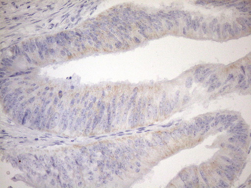PPIF / Cyclophilin F Antibody - Immunohistochemical staining of paraffin-embedded Adenocarcinoma of Human colon tissue using anti-PPIF mouse monoclonal antibody. (Heat-induced epitope retrieval by 1mM EDTA in 10mM Tris buffer. (pH8.5) at 120°C for 3 min. (1:150)