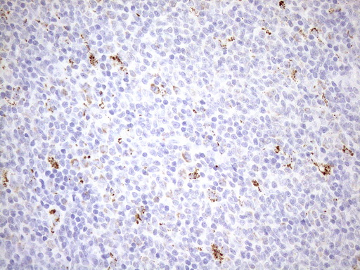 PPIF / Cyclophilin F Antibody - Immunohistochemical staining of paraffin-embedded Human lymphoma tissue using anti-PPIF mouse monoclonal antibody. (Heat-induced epitope retrieval by 1mM EDTA in 10mM Tris buffer. (pH8.5) at 120°C for 3 min. (1:150)