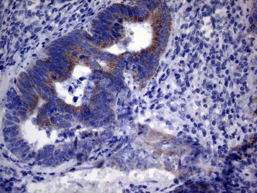 PPIF / Cyclophilin F Antibody - Immunohistochemical staining of paraffin-embedded Adenocarcinoma of Human colon tissue using anti-PPIF mouse monoclonal antibody. (Heat-induced epitope retrieval by 1mM EDTA in 10mM Tris buffer. (pH8.5) at 120°C for 3 min. (1:150)