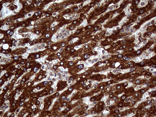 PPIF / Cyclophilin F Antibody - Immunohistochemical staining of paraffin-embedded Carcinoma of Human liver tissue using anti-PPIF mouse monoclonal antibody. (Heat-induced epitope retrieval by 1mM EDTA in 10mM Tris buffer. (pH8.5) at 120°C for 3 min. (1:1000)