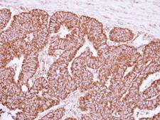 PPIF / Cyclophilin F Antibody - IHC of paraffin-embedded Colon ca, using PPIF antibody at 1:250 dilution.