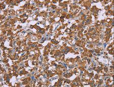 PPIF / Cyclophilin F Antibody - Immunohistochemistry of paraffin-embedded Human thyroid cancer using PPIF Polyclonal Antibody at dilution of 1:45.