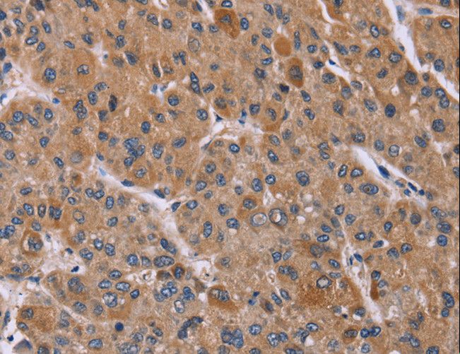 PPIF / Cyclophilin F Antibody - Immunohistochemistry of paraffin-embedded Human liver cancer using PPIF Polyclonal Antibody at dilution of 1:45.