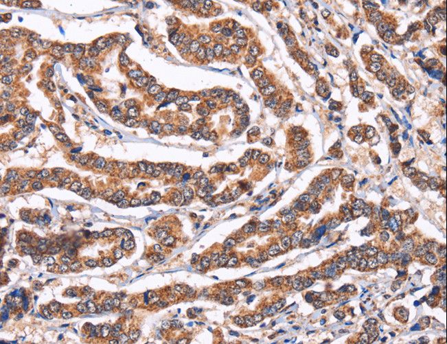 PPIF / Cyclophilin F Antibody - Immunohistochemistry of paraffin-embedded Human breast cancer using PPIF Polyclonal Antibody at dilution of 1:60.