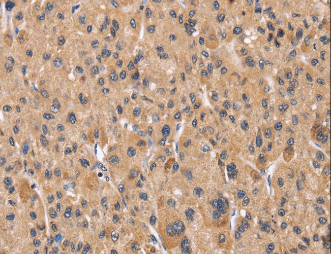 PPIF / Cyclophilin F Antibody - Immunohistochemistry of paraffin-embedded Human liver cancer using PPIF Polyclonal Antibody at dilution of 1:60.