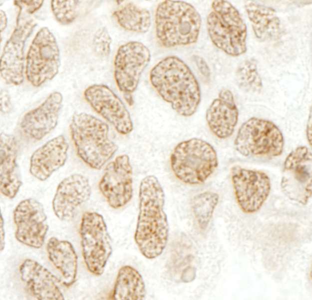 PPIG / Cyclophilin G Antibody - Detection of Human SRcyp by Immunohistochemistry. Sample: FFPE section of human ovarian carcinoma. Antibody: Affinity purified rabbit anti-SRcyp used at a dilution of 1:250.