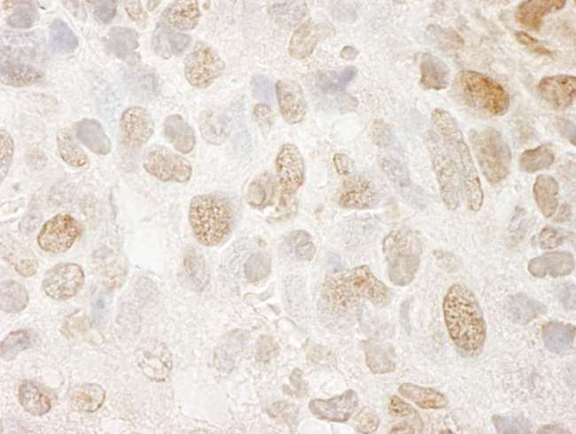 PPIG / Cyclophilin G Antibody - Detection of Mouse SRcyp Immunohistochemistry. Sample: FFPE section of mouse renal cell carcinoma. Antibody: Affinity purified rabbit anti-SRcyp used at a dilution of 1:250.