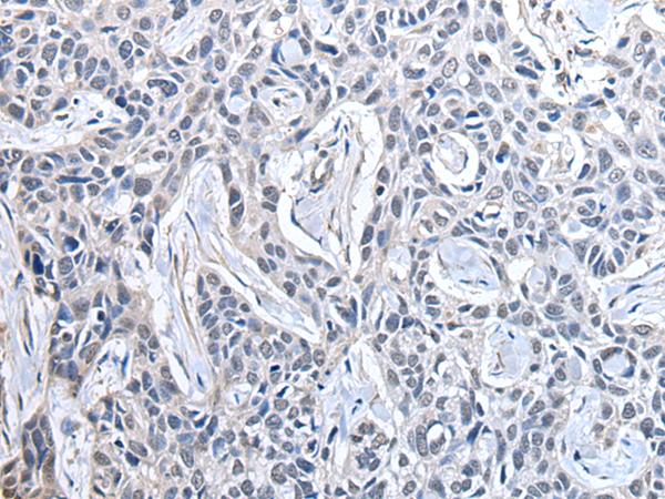 PPIG / Cyclophilin G Antibody - Immunohistochemistry of paraffin-embedded Human lung cancer tissue  using PPIG Polyclonal Antibody at dilution of 1:50(×200)