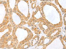 PPIH / Cyclophilin H Antibody - Immunohistochemistry of paraffin-embedded Human thyroid cancer tissue  using PPIH Polyclonal Antibody at dilution of 1:60(×200)