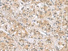 PPIH / Cyclophilin H Antibody - Immunohistochemistry of paraffin-embedded Human liver cancer tissue  using PPIH Polyclonal Antibody at dilution of 1:70(×200)