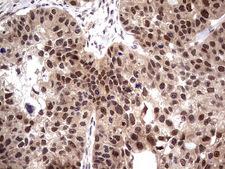 PPIL1 Antibody - IHC of paraffin-embedded Carcinoma of Human kidney tissue using anti-PPIL1 mouse monoclonal antibody. (Heat-induced epitope retrieval by 1 mM EDTA in 10mM Tris, pH8.5, 120°C for 3min).