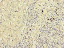 PPIL2 / CYP60 Antibody - Immunohistochemistry of paraffin-embedded human liver cancer at dilution 1:100