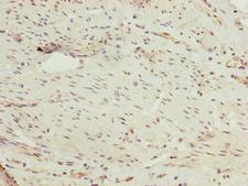 PPIL4 Antibody - Immunohistochemistry of paraffin-embedded human bladder cancer using PPIL4 Antibody at dilution of 1:100