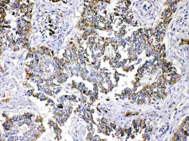 PPL / Periplakin Antibody - Periplakin was detected in paraffin-embedded sections of human lung cancer tissues using rabbit anti- Periplakin Antigen Affinity purified polyclonal antibody