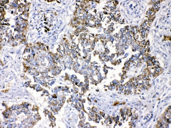 PPL / Periplakin Antibody - IHC testing of FFEP human lung cancer tissue with Periplakin antibody at 1ug/ml. Required HIER: steam section in pH6 citrate buffer for 20 min and allow to cool prior to testing.