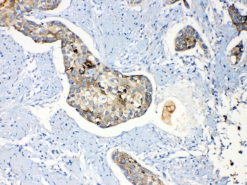 PPL / Periplakin Antibody - IHC testing of FFEP human esophagus squama cancer tissue with Periplakin antibody at 1ug/ml. Required HIER: steam section in pH6 citrate buffer for 20 min and allow to cool prior to testing.
