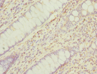 PPM1A / PP2CA Antibody - Immunohistochemistry of paraffin-embedded human colon cancer at dilution 1:100