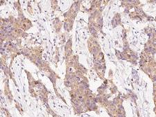 PPM1A / PP2CA Antibody - Immunochemical staining of human PPM1A in human breast carcinoma with rabbit polyclonal antibody at 1:3000 dilution, formalin-fixed paraffin embedded sections.