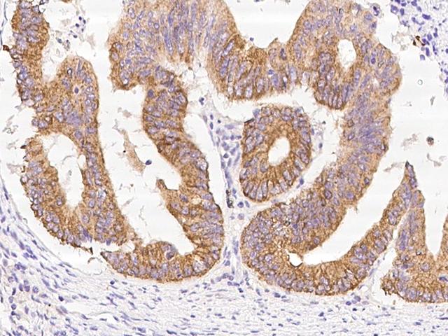 PPM1A / PP2CA Antibody - Immunochemical staining of human PPM1A in human colon carcinoma with rabbit polyclonal antibody at 1:3000 dilution, formalin-fixed paraffin embedded sections.