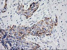 PPM1B Antibody - IHC of paraffin-embedded Adenocarcinoma of Human breast tissue using anti-PPM1B mouse monoclonal antibody.
