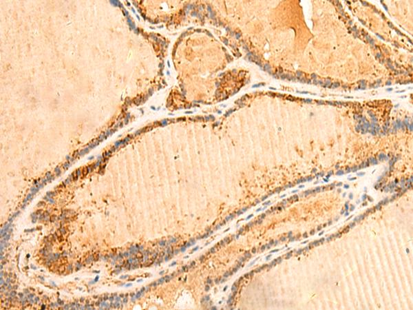 PPM1B Antibody - Immunohistochemistry of paraffin-embedded Human thyroid cancer tissue  using PPM1B Polyclonal Antibody at dilution of 1:50(×200)