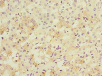 PPM1D / WIP1 Antibody - Immunohistochemistry of paraffin-embedded human liver cancer at dilution 1:100