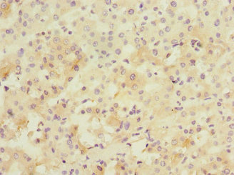 PPM1D / WIP1 Antibody - Immunohistochemistry of paraffin-embedded human liver cancer at dilution 1:100