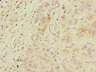 PPM1D / WIP1 Antibody - Immunohistochemistry of paraffin-embedded human liver cancer using PPM1D Antibody at dilution of 1:100
