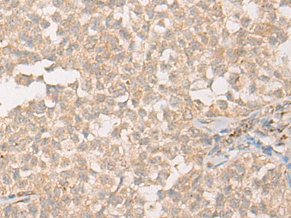 PPM1D / WIP1 Antibody - Immunohistochemistry of paraffin-embedded Human ovarian cancer tissue  using PPM1D Polyclonal Antibody at dilution of 1:60(×200)