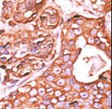 PPM1F Antibody - Formalin-fixed and paraffin-embedded human cancer tissue reacted with the primary antibody, which was peroxidase-conjugated to the secondary antibody, followed by AEC staining. This data demonstrates the use of this antibody for immunohistochemistry; clinical relevance has not been evaluated. BC = breast carcinoma; HC = hepatocarcinoma.