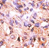 PPM1F Antibody - Formalin-fixed and paraffin-embedded human cancer tissue reacted with the primary antibody, which was peroxidase-conjugated to the secondary antibody, followed by AEC staining. This data demonstrates the use of this antibody for immunohistochemistry; clinical relevance has not been evaluated. BC = breast carcinoma; HC = hepatocarcinoma.