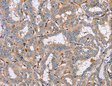 PPM1F Antibody - Immunohistochemistry of paraffin-embedded Human thyroid cancer using PPM1F Polyclonal Antibody at dilution of 1:40.