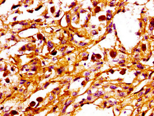 PPM1F Antibody - Immunohistochemistry image at a dilution of 1:100 and staining in paraffin-embedded human melanoma cancer performed on a Leica BondTM system. After dewaxing and hydration, antigen retrieval was mediated by high pressure in a citrate buffer (pH 6.0) . Section was blocked with 10% normal goat serum 30min at RT. Then primary antibody (1% BSA) was incubated at 4 °C overnight. The primary is detected by a biotinylated secondary antibody and visualized using an HRP conjugated SP system.