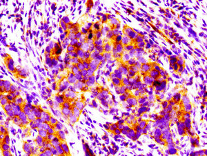 PPM1F Antibody - Immunohistochemistry image at a dilution of 1:100 and staining in paraffin-embedded human pancreatic cancer performed on a Leica BondTM system. After dewaxing and hydration, antigen retrieval was mediated by high pressure in a citrate buffer (pH 6.0) . Section was blocked with 10% normal goat serum 30min at RT. Then primary antibody (1% BSA) was incubated at 4 °C overnight. The primary is detected by a biotinylated secondary antibody and visualized using an HRP conjugated SP system.