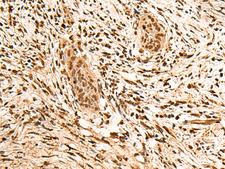 PPM1G Antibody - Immunohistochemistry of paraffin-embedded Human esophagus cancer tissue  using PPM1G Polyclonal Antibody at dilution of 1:40(×200)