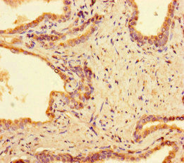 PPM1H Antibody - Immunohistochemistry of paraffin-embedded human prostate cancer at dilution of 1:100