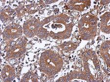PPM1J Antibody - IHC of paraffin-embedded Colon ca, using PPM1J antibody at 1:500 dilution.